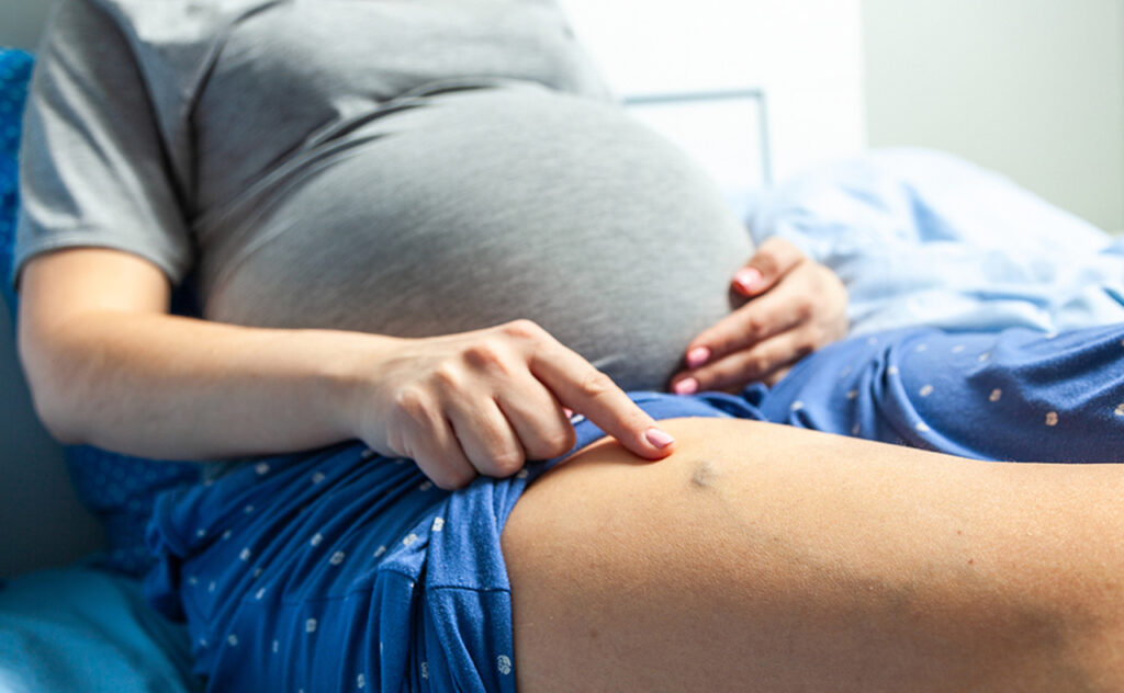 Varicose veins in pregnant women. Woman sits on bed and points her finger at swollen veins.
