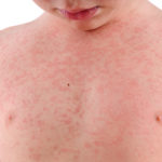 Meningococcal disease: What is it, how does it spread, and what can you do to stay safe?