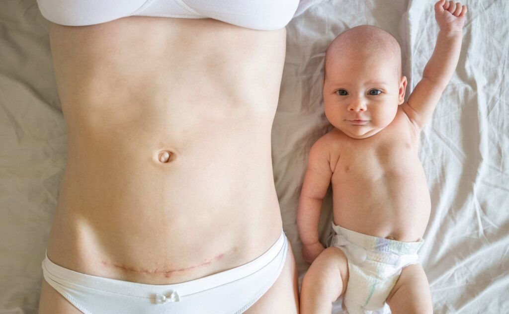 New mother laying next to baby with c-section scar