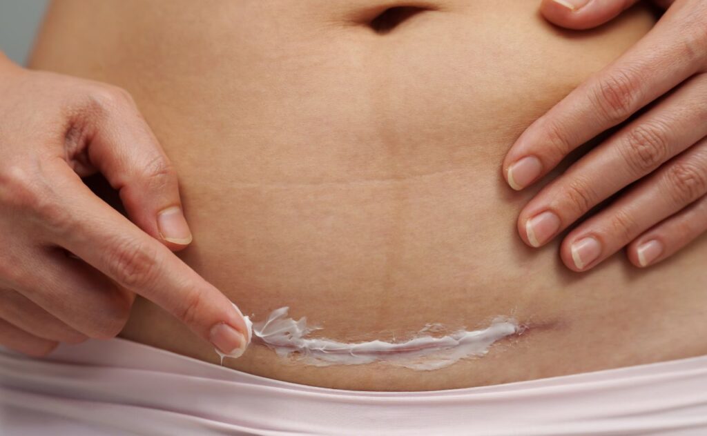 Woman putting healing cream in c-section scar of caesarean