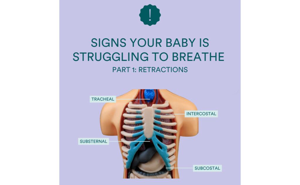 Tiny hearts education infographic on intercostal chest retractions.