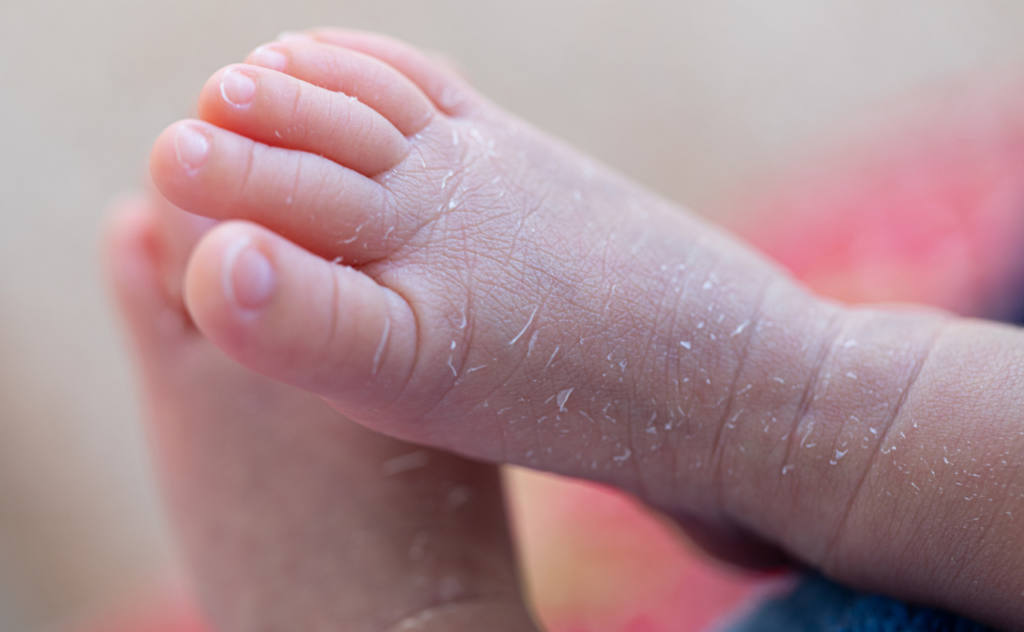 Close of newborn baby's feet with dry flaky skin