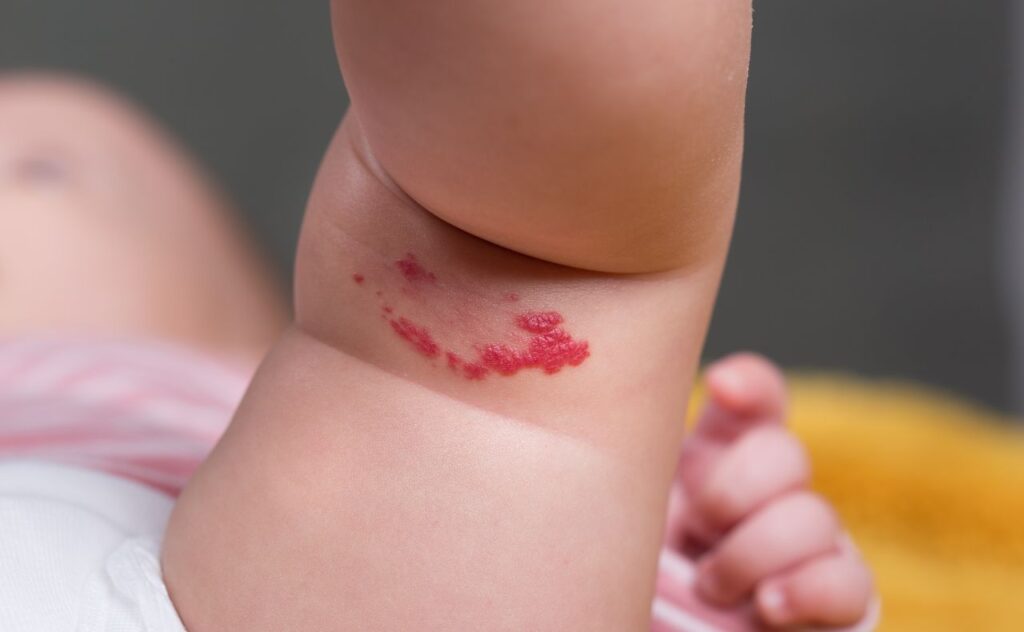 Image of red bumpy birthmark or hemangioms on the back of a baby's knee